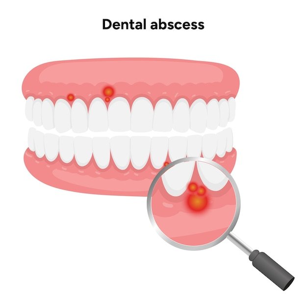 Handdrawn dental illustration tooth with a dental abscess visible infection swollen gum area